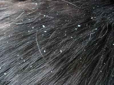 Natural Hair Tips for Controlling Dandruff